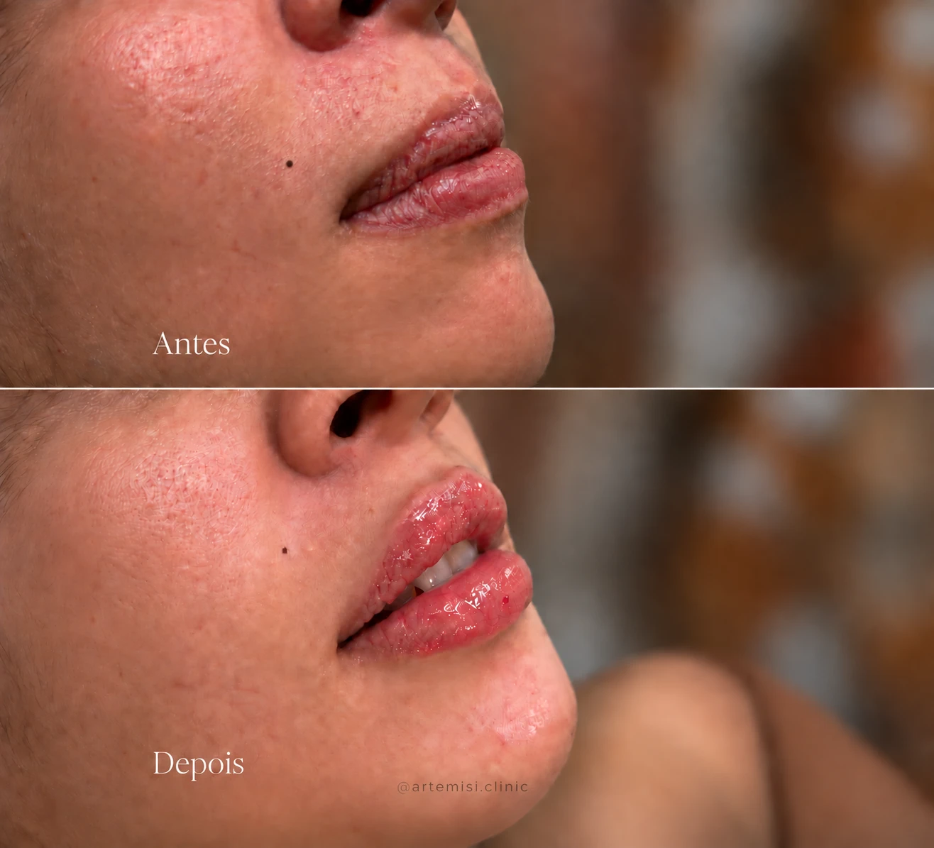 Antes e depois de preenchimento labial realizado na Artemisi